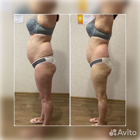 Массаж ручной и аппаратный LPG